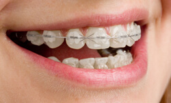 image of Clear Braces