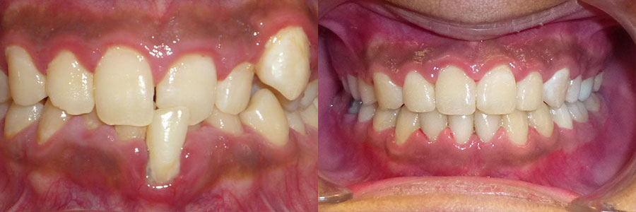 before and after of braces treatment