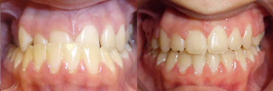 before and after of braces treatment
