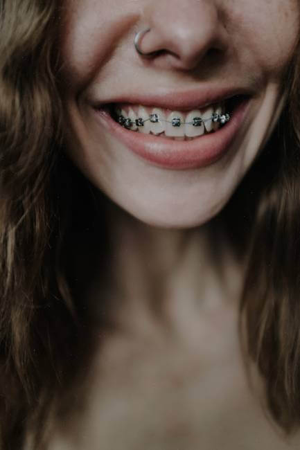 Types Of Braces for Adults