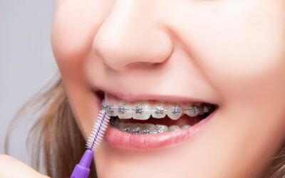 Invisalign vs Braces: What’s the Right Choice for You?