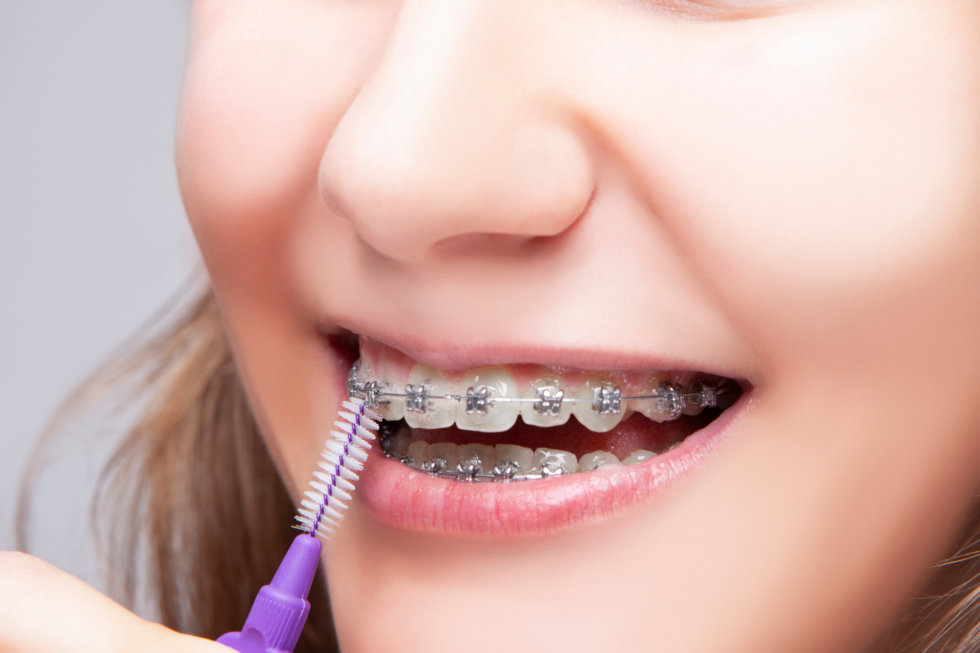 Invisalign Vs Braces All About Braces Colorado Orthodontists 