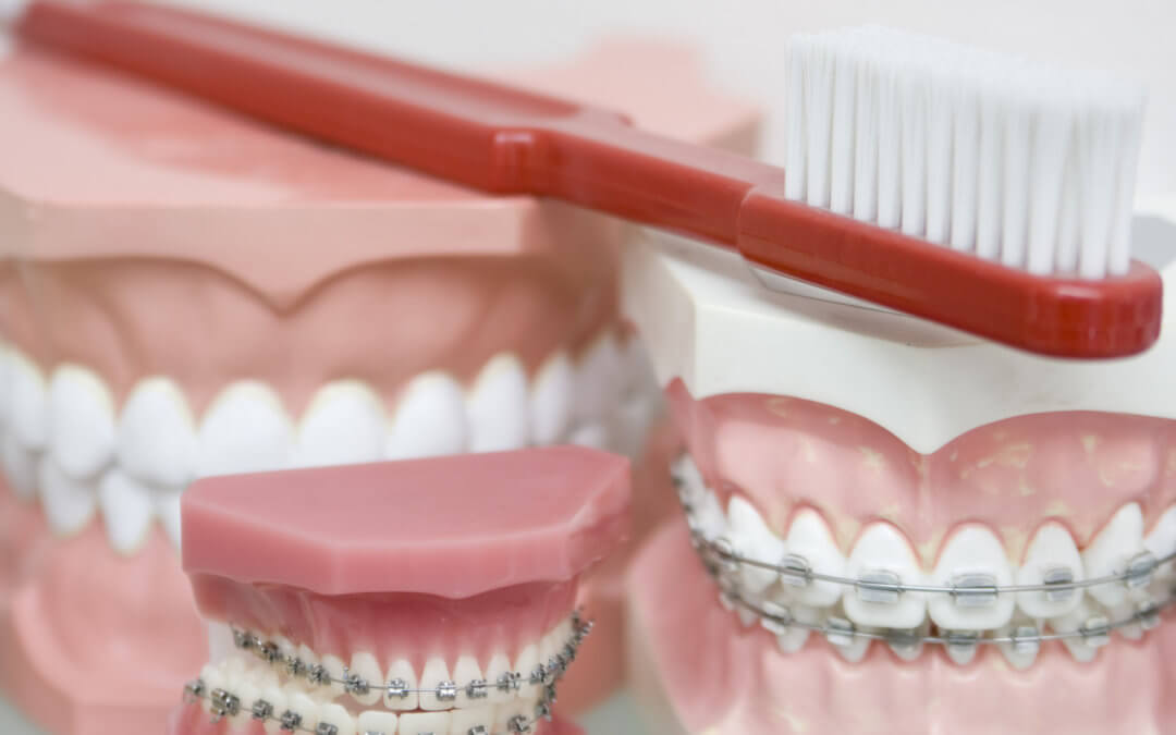 Find a Colorado Orthodontist that will show you how to take care of your teeth.