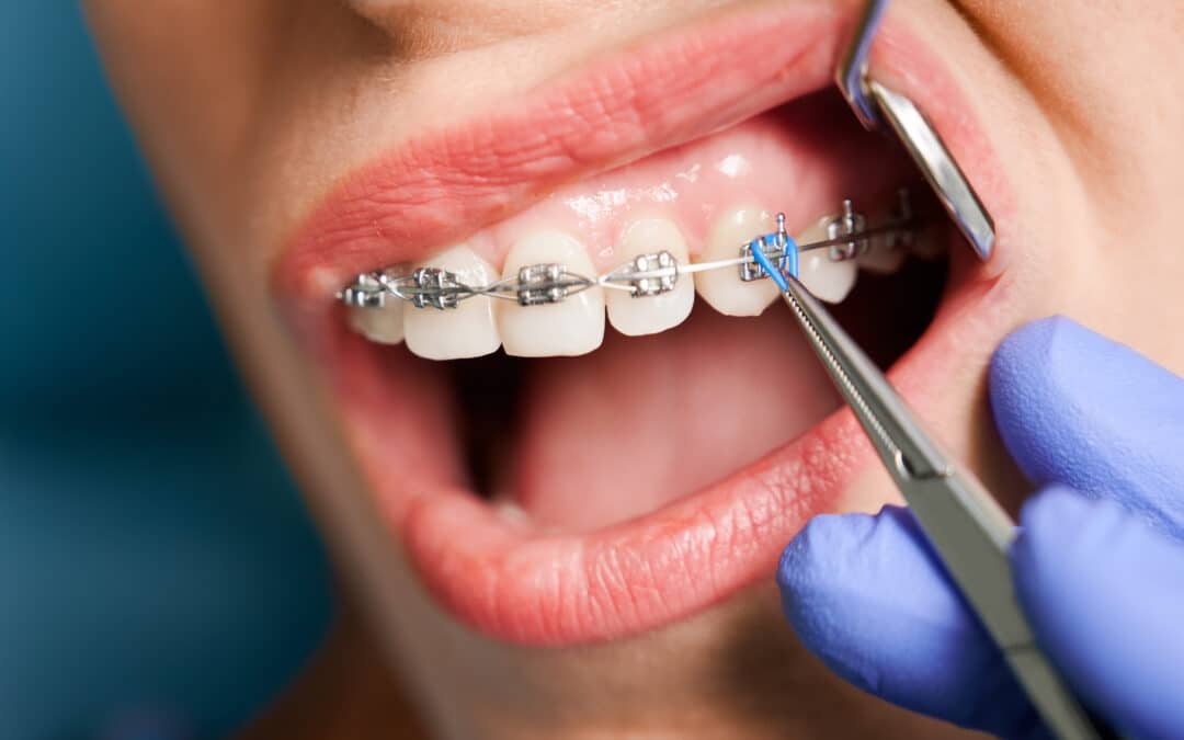 Braces 101: How Braces Work and the Importance of Regular Adjustments